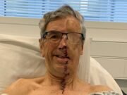 Pionero del NHS le da una ‘cara impresa en 3D’ a un ciclista de 75 años, que sufrió horribles lesiones faciales por un conductor ebrio