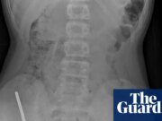 Los cirujanos extraen 100 imanes de los intestinos de un adolescente de Nueva Zelanda | Nueva Zelanda
