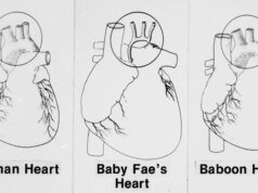 El 26 de octubre, el recién nacido recibió un corazón de babuino en un trasplante experimental