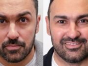 La ex estrella del Aston Villa muestra increíbles resultados de trasplante de cabello que ‘lo hicieron sentir cinco años más joven’