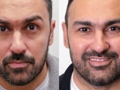 La ex estrella del Aston Villa muestra increíbles resultados de trasplante de cabello que ‘lo hicieron sentir cinco años más joven’