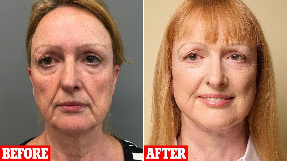 Este procedimiento de ‘apariencia natural’ transformó mis mejillas caídas y caídas y mis mejillas hundidas y me hizo lucir años más joven. Ahora la gente se sorprende cuando les digo mi edad real.