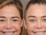 El médico de Denise Richards comparte fotos de antes y después del estiramiento facial