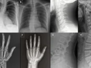 Las radiografías deepfake son tan reales que ni siquiera los médicos pueden notar la diferencia