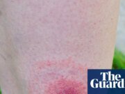 La incidencia de la enfermedad de Lyme en Inglaterra ha aumentado más de un 20% en un año Enfermedad de Lyme