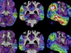 Los británicos lanzarán un innovador análisis de sangre para el Alzheimer que predice si usted contraerá la enfermedad años antes de que aparezcan los síntomas, pero ¿lo realizará?