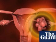 Las mujeres con períodos irregulares deberían hacerse pruebas de PMOS, dice el NHS Health